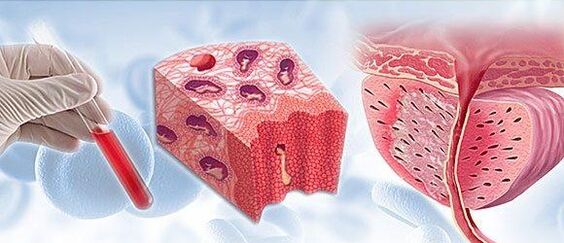 vereanalüüs prostatiidi diagnoosimiseks